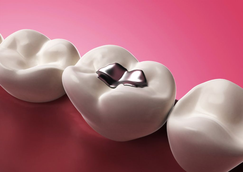 Emergenza mercurio: l’Unione europea corre ai ripari limitando l'uso dell'amalgama